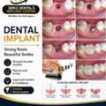 Wondering About Dental Implant Costs? Get A Clear Answer.
