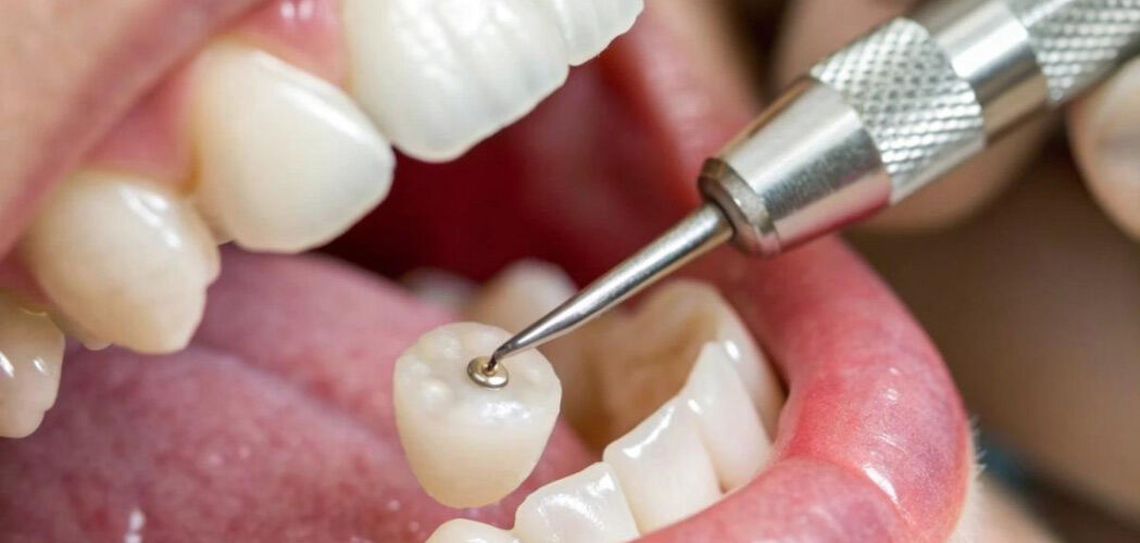 New York, Dental, What Is A Dental Prophy? A Guide To Preventive Teeth Cleaning