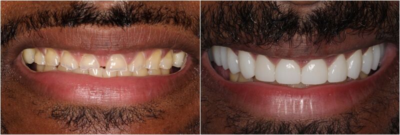 Dublin, Dental, Dublin Metro Dental &ndash; Porcelain Crowns For Strong, Natural-Looking Smiles