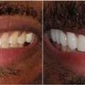 Dublin Metro Dental – Porcelain Crowns For Strong, Natural-Looking Smiles