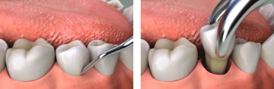 Al Nahda, Dental, Tooth Extraction Clinic In Al Nahda - AFFORD Clinic In Al Nahda Dubai