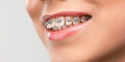 Abu Dhabi, Dental, Orthodontists In Abu Dhabi | Dental Braces In Abu Dhabi