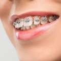 Orthodontists In Abu Dhabi | Dental Braces In Abu Dhabi