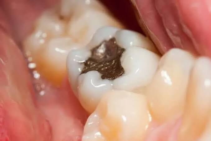 Singapore, Dental, 5 Common Types Of Dental Fillings And Their Costs In Singapore