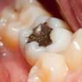 5 Common Types Of Dental Fillings And Their Costs In Singapore