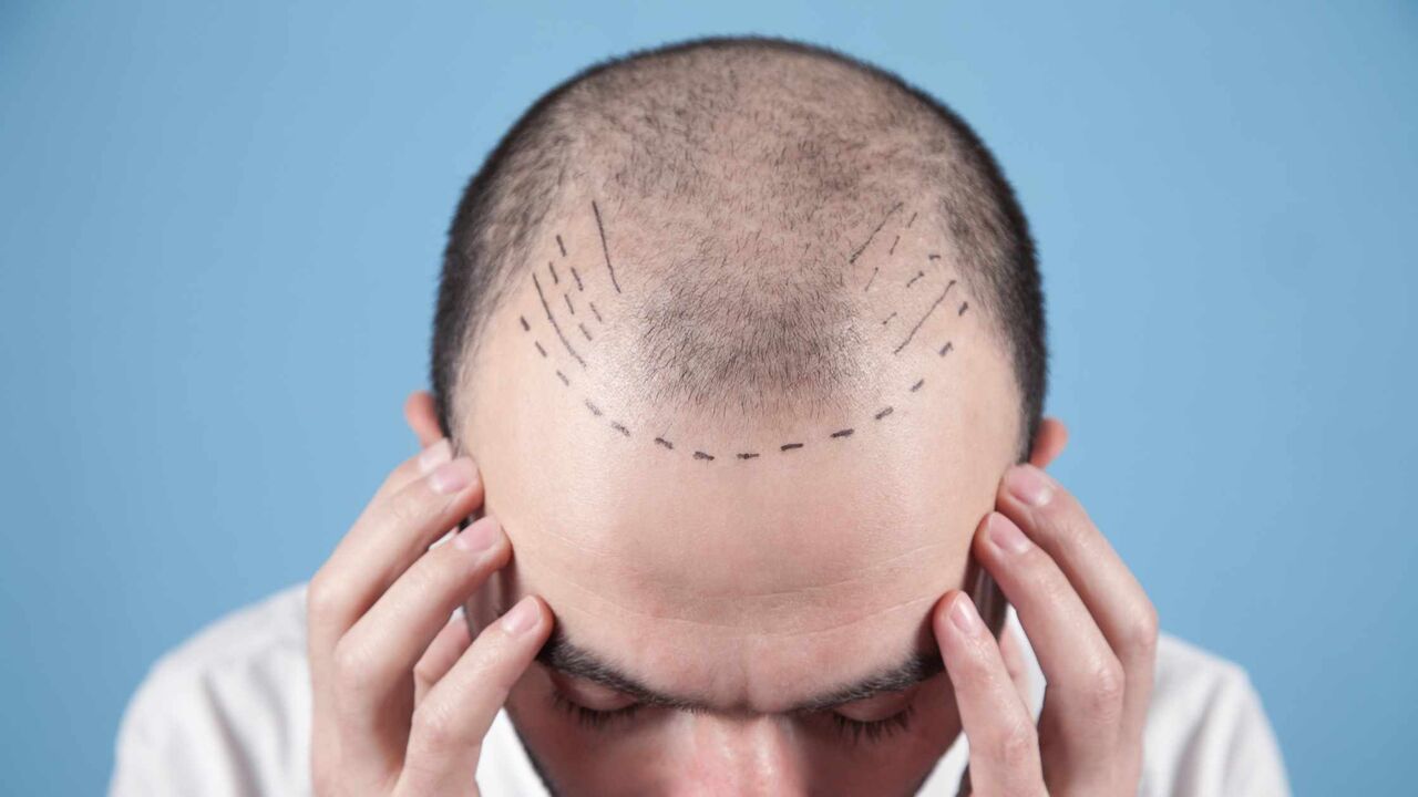 Mumbai, General, Advanced Hair Transplant In Navi Mumbai For Natural-Looking Results