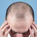Advanced Hair Transplant In Navi Mumbai For Natural-Looking Results