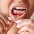 Restore Healthy Gums With Treatment In Greensborough