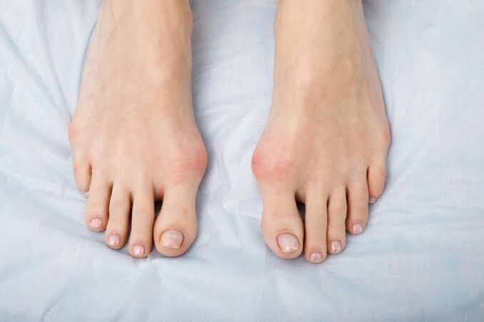 Singapore, Health, Is Bunion Removal Surgery Right For You? Key Questions To Ask