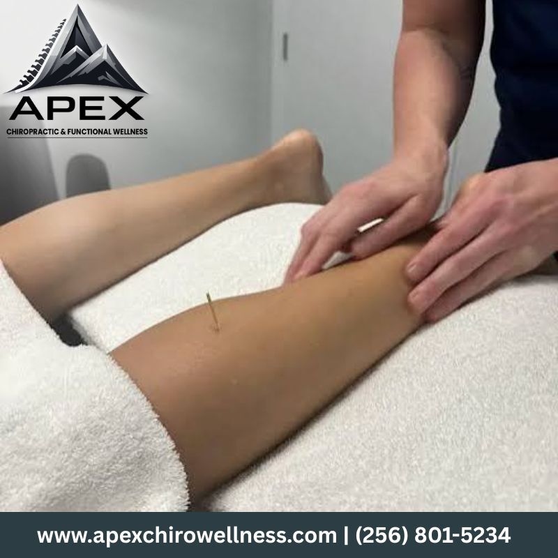 New York, Health, Dry Needling In Hampton Cove | Apex Chiropractic & Functional Wellness