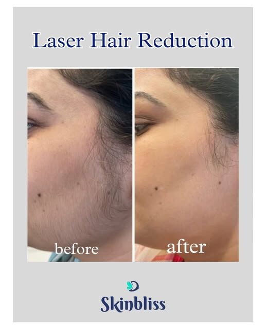Hyderabad, Health, Laser Hair Removal Clinic In Hyderabad