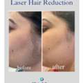 Laser Hair Removal Clinic In Hyderabad