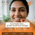 Invisalign Aligners In Hyderabad