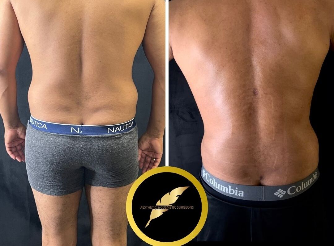 Los Angeles, Health, Awake High Definition Liposuction In LA &ndash; Sculpted Results, No General Anesthesia