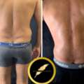 Awake High Definition Liposuction In LA &ndash; Sculpted Results, No General Anesthesia