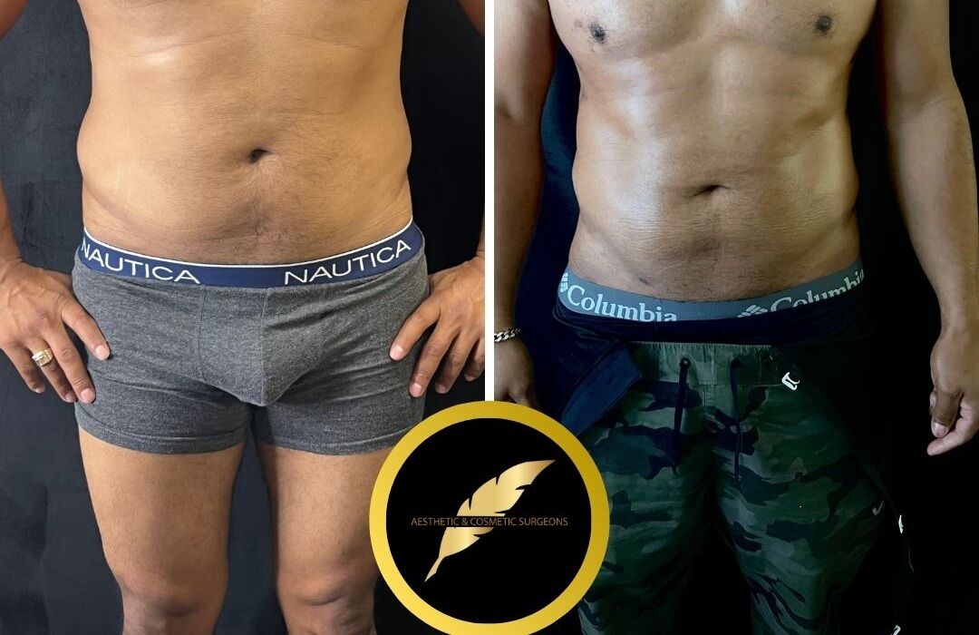 Los Angeles, Health, Awake High Definition Liposuction In LA &ndash; Sculpted Results, No General Anesthesia