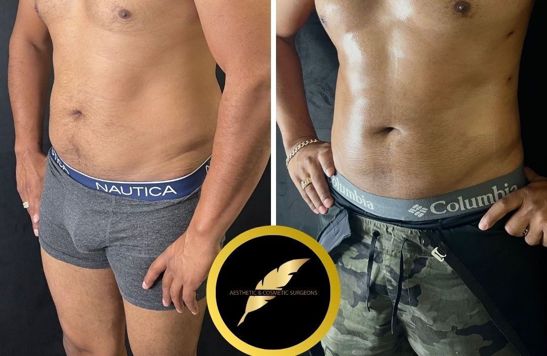 Los Angeles, Health, Awake High Definition Liposuction In LA &ndash; Sculpted Results, No General Anesthesia
