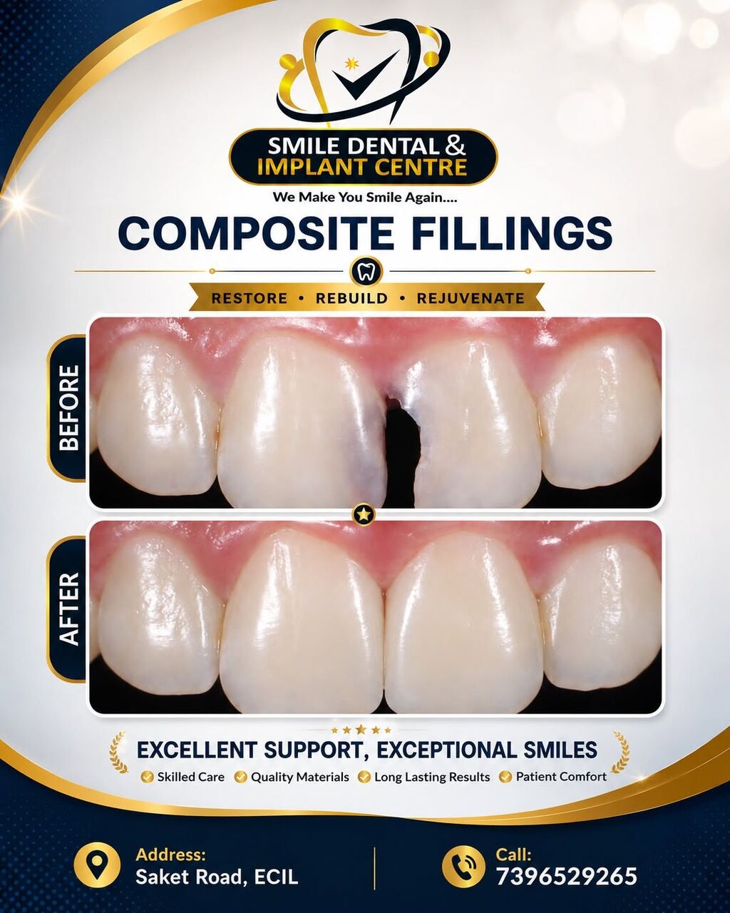 Hyderabad, Dental, Chipped Or Decayed Front Teeth? Get Invisible Fillings At Smile Dental!