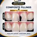 Chipped Or Decayed Front Teeth? Get Invisible Fillings At Smile Dental!