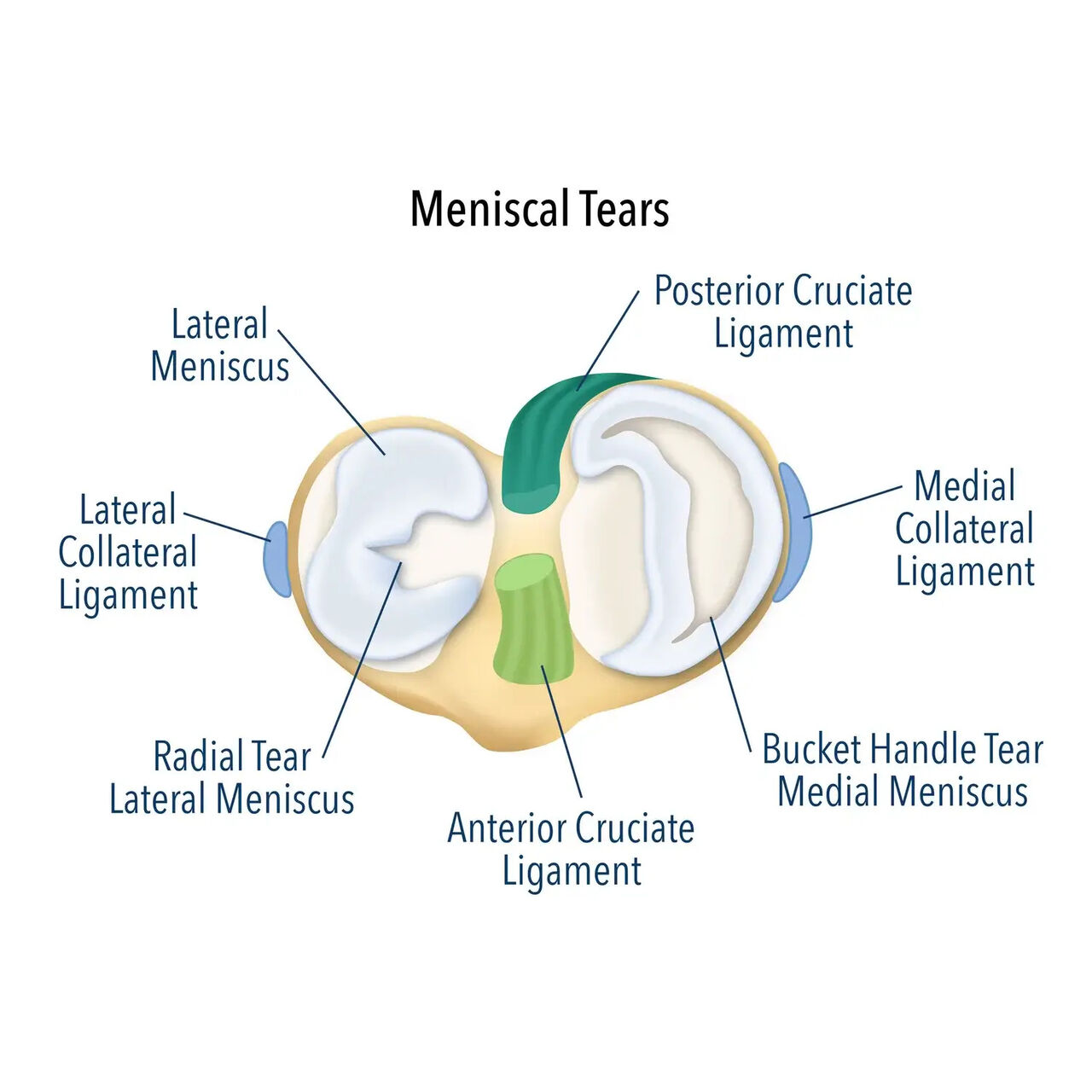 Melbourne, Health, What Happens After A Knee Meniscal Tear Is Diagnosed