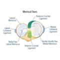 What Happens After A Knee Meniscal Tear Is Diagnosed