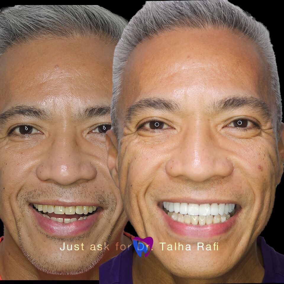 Edinburgh, Dental, Teeth Whitening Cambridge &ndash; Professional Teeth Whitening For A Brighter Smile