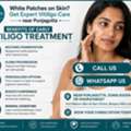 INR 5000,  Vitiligo Treatment Near Somajiguda | White Spots On Skin?