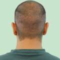 Activate Your Hair's Natural Power With PRP Treatment In Delhi!
