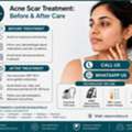 INR 2499,  Acne Scar Treatment In Kukatpally | Scars Bothering You?
