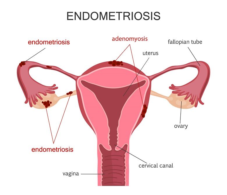 Abu Dhabi, Health, Best Endometriosis Specialist In Abu Dhabi