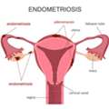 Best Endometriosis Specialist In Abu Dhabi
