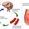RSD Mobility Improvement Treatment In Gurgaon