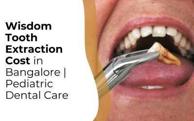 Bangalore, Dental, Wisdom Tooth Extraction Cost Bangalore &mdash; What You Should Know