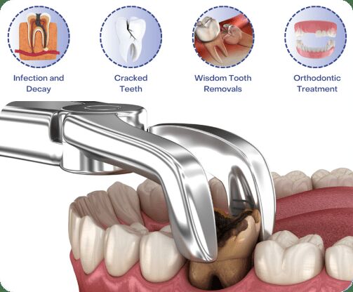 Bangalore, Dental, Wisdom Tooth Extraction Cost Bangalore &mdash; What You Should Know