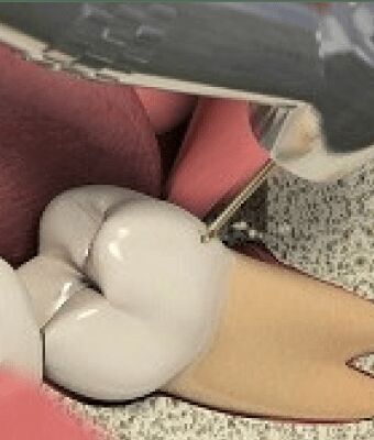 Bangalore, Dental, Wisdom Tooth Extraction Cost Bangalore &mdash; What You Should Know