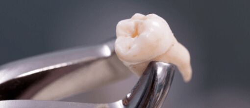 Bangalore, Dental, Wisdom Tooth Extraction Cost Bangalore &mdash; What You Should Know