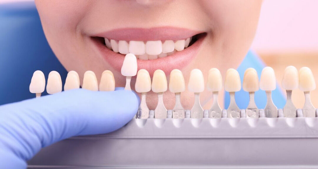 Perth, Dental, Top Guide About Tooth Coloured Fillings From Nearby Dental Clinic In Ormeau City