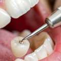 Price Of Dental Cap: Full Cost & Types Guide