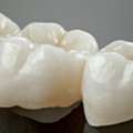 Same-Day Crowns Miami For Fast, Precise Smile Restoration Today