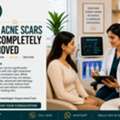 What Are The Treatment Options For Acne Scar Treatment?
