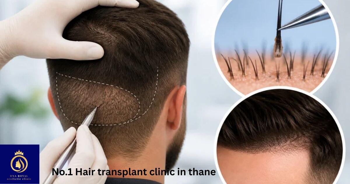 Thane, Fashion & Design, Advanced No.1 Hair Transplant Clinic In Thane &ndash; DNA Royal.