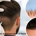Advanced No.1 Hair Transplant Clinic In Thane &ndash; DNA Royal.