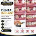 Flapless Dental Implant Treatment In ECIL - AS Rao Nagar And Nearby Areas