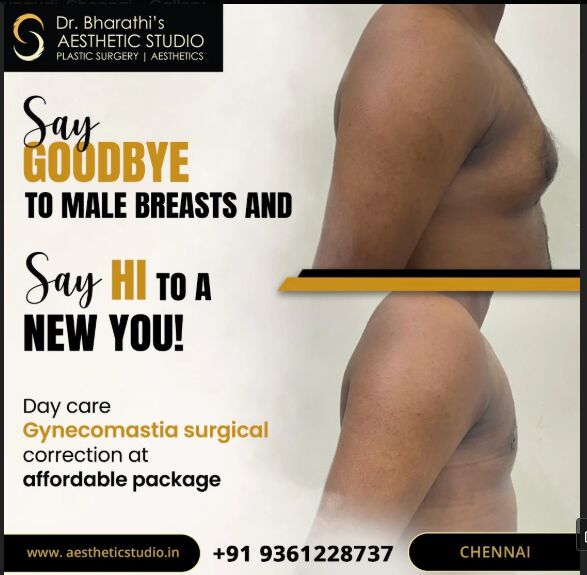 Chennai, Health, Gynecomastia Surgery In Chennai | Aesthetic Studio
