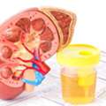 Protein In Urine Treatment In Delhi