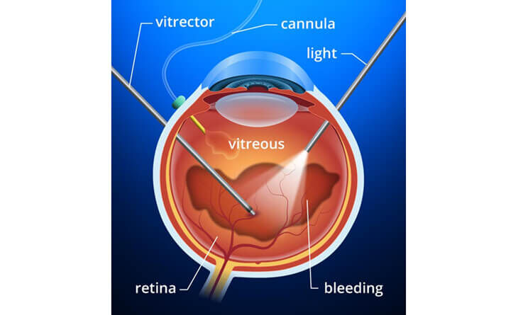 New Delhi, Health, Is Retina Operation Risky? Risks & Recovery Explained