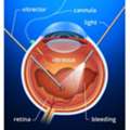 Is Retina Operation Risky? Risks & Recovery Explained