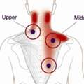 Trigger Point Pain Treatment For Muscle Tension Gurgaon