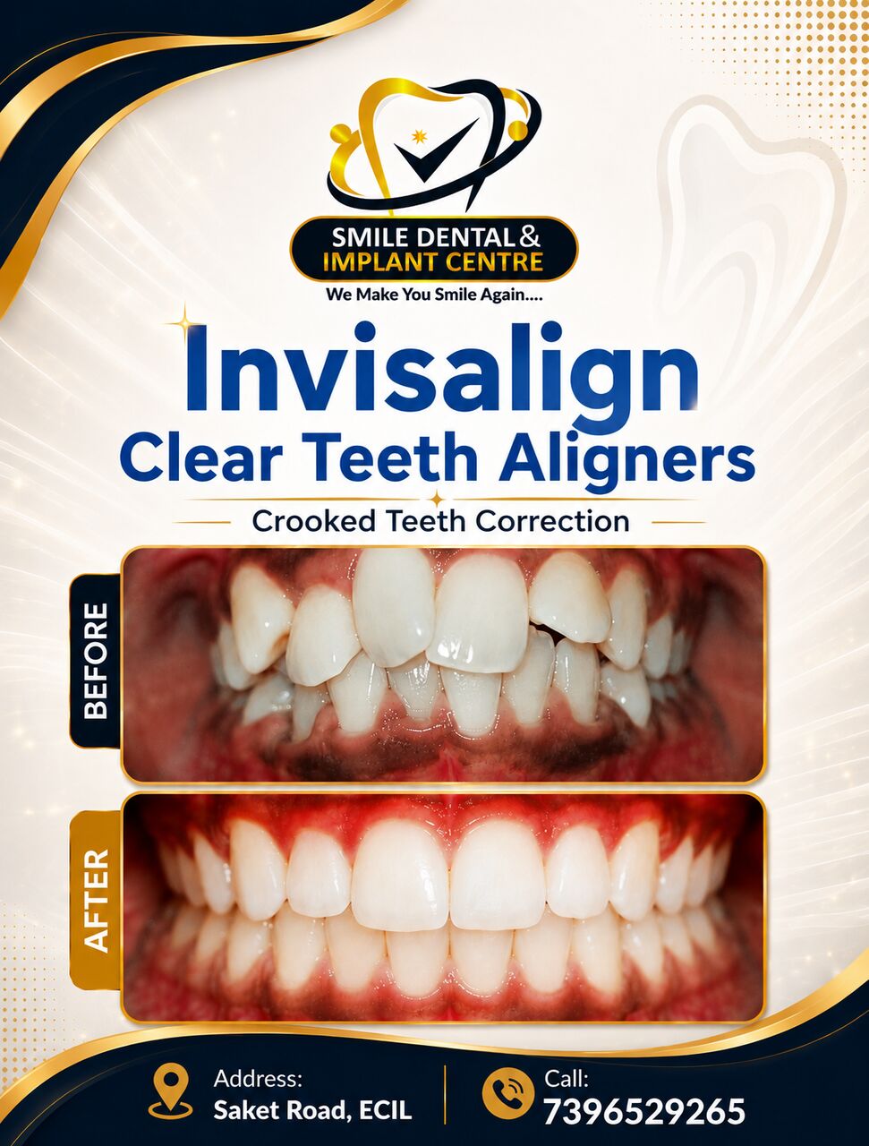 Hyderabad, Dental, Clear Aligners For Teeth Straightening In ECIL, AS Rao Nagar And Nearby Areas