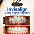 Clear Aligners For Teeth Straightening In ECIL, AS Rao Nagar And Nearby Areas